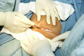 12.Cesarean Section (C-Section)